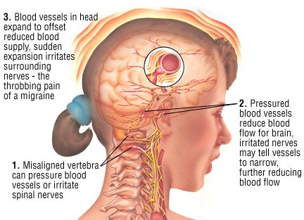 Chiropractic Care help with Migraines