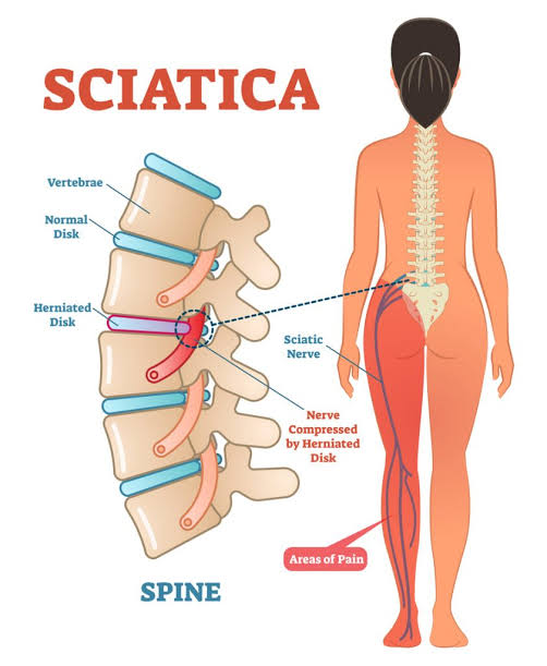 Chiropractors Help Relieve Sciatica